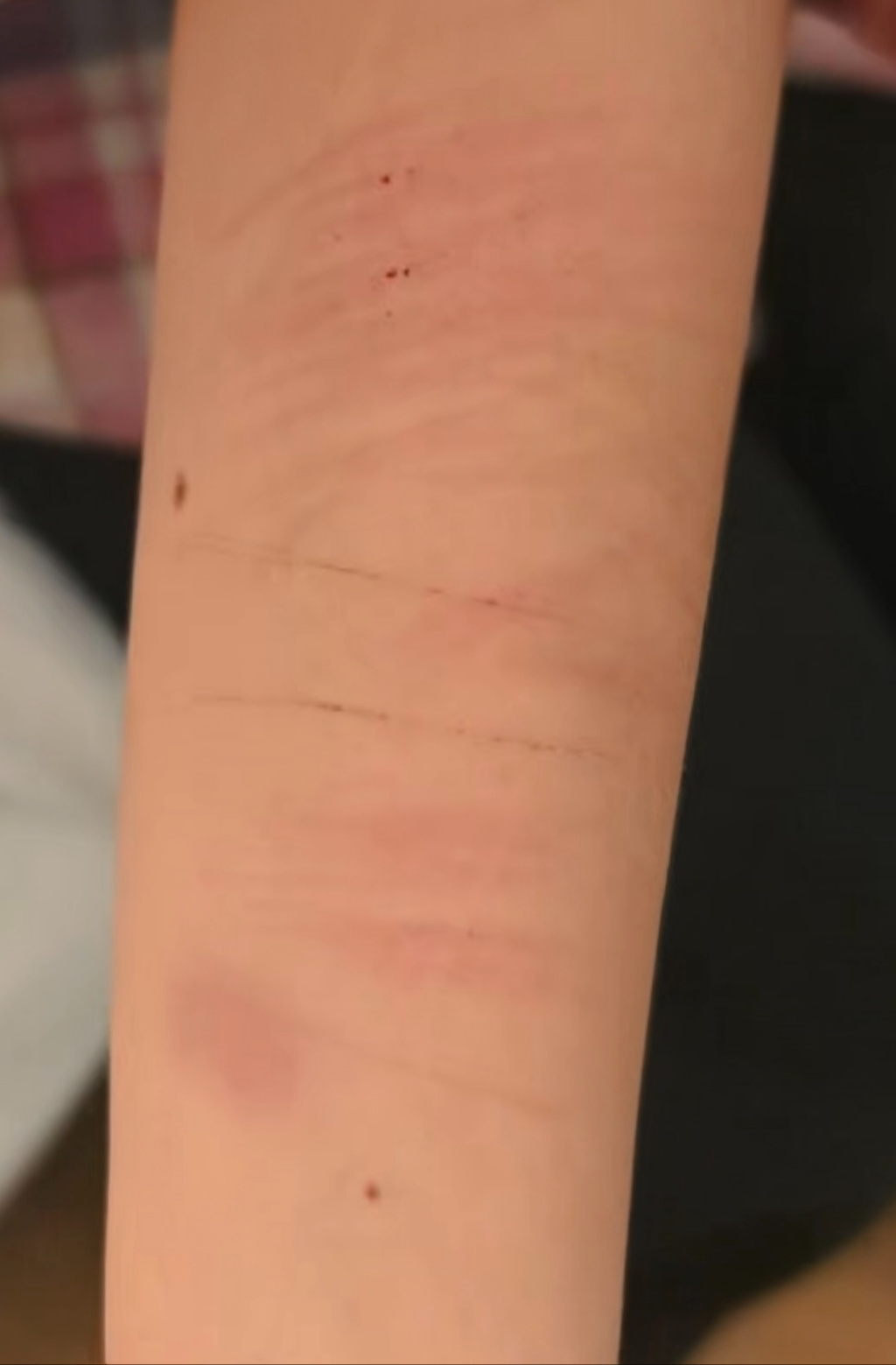 案发后，牟晓丽曾多次割腕自伤
